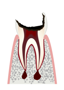 歯冠が大きく失われた歯