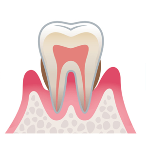 歯周炎