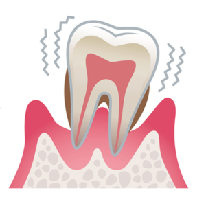 重度の歯周炎